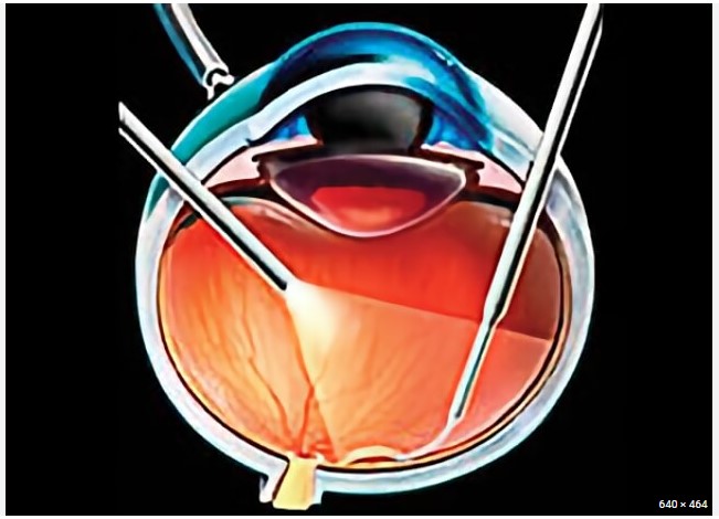 houston macular pucker treatment 
